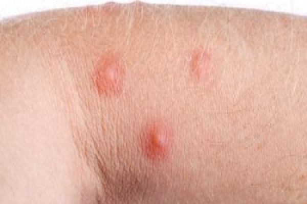 bug bites